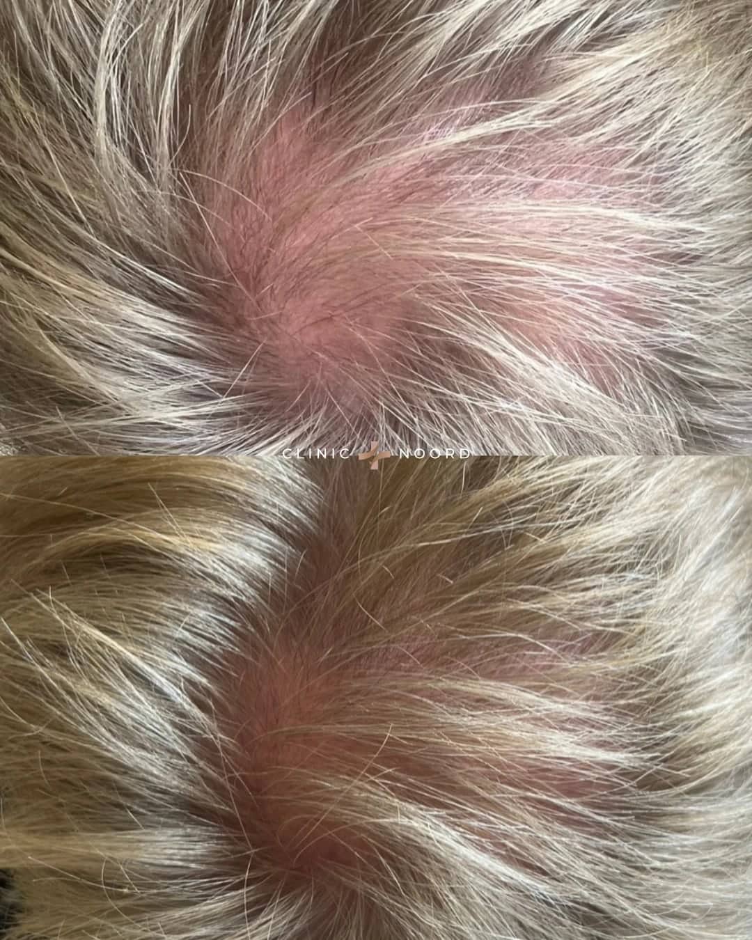 Na: Voor en na een PRP-behandeling (Platelet Rich Plasma) voor het haar bij Clinic Noord
